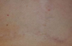 breast-surgical-scar-after