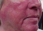 facial-redness-before