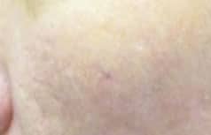 pitteda-acne-scarring-after